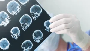Novo Guideline e Tratamento do AVC Isquêmico 2026: O que Mudou nas Diretrizes da AHA/ASA?